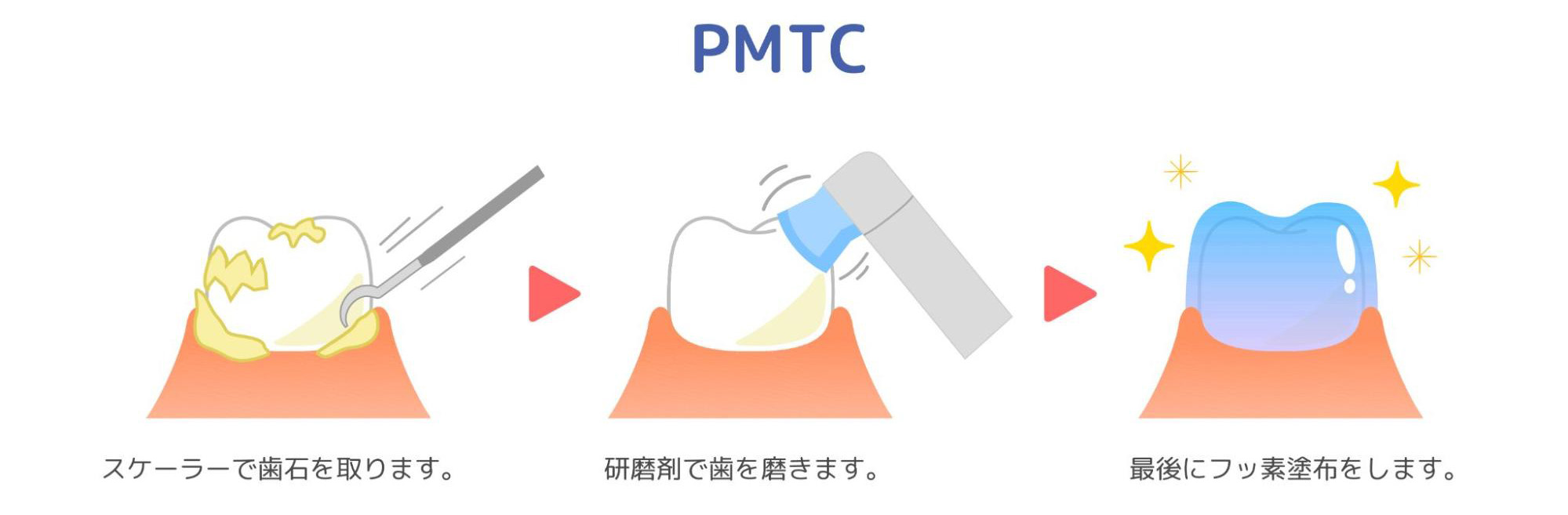 プロによるクリーニング(PMTC)