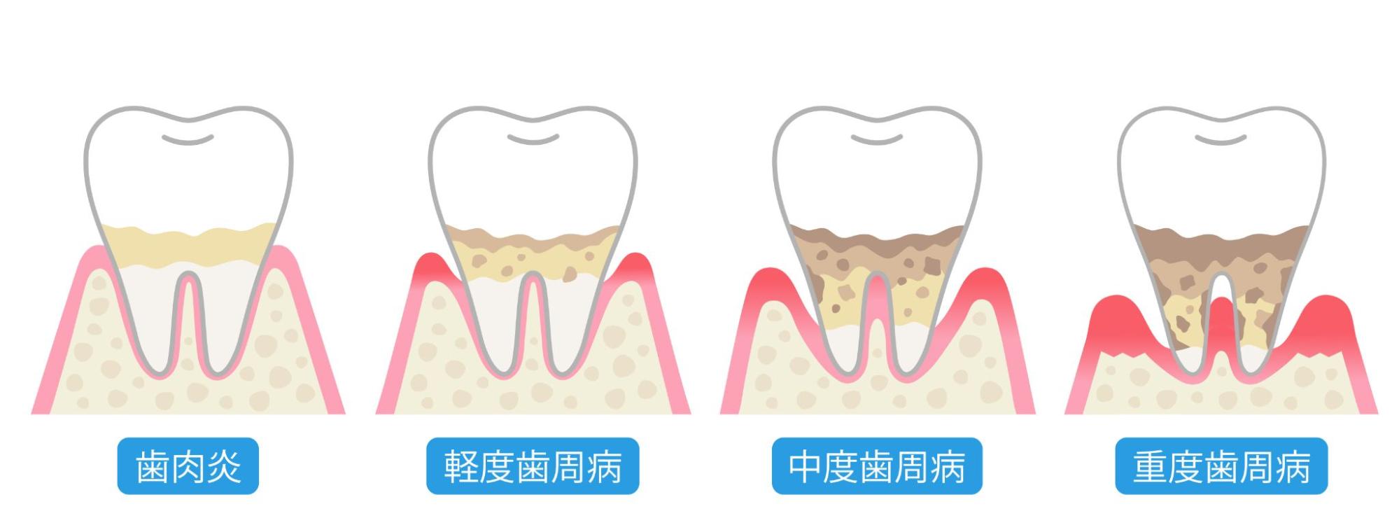 歯周病の進行ステージと自覚症状
